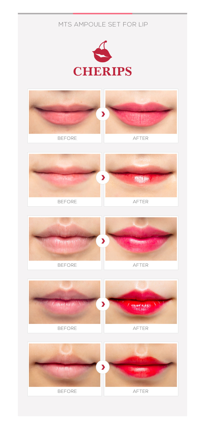 Sistema de terapia con microagujas Stayve Cheerips - Juegos de ampollas para labios
