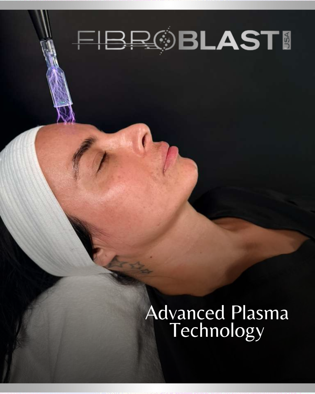 Plasma Fibroblast