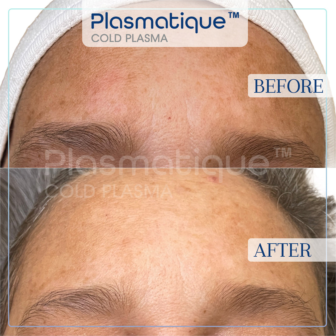 Plasmatique Cold Plasma Device Official Kit and Free Certification