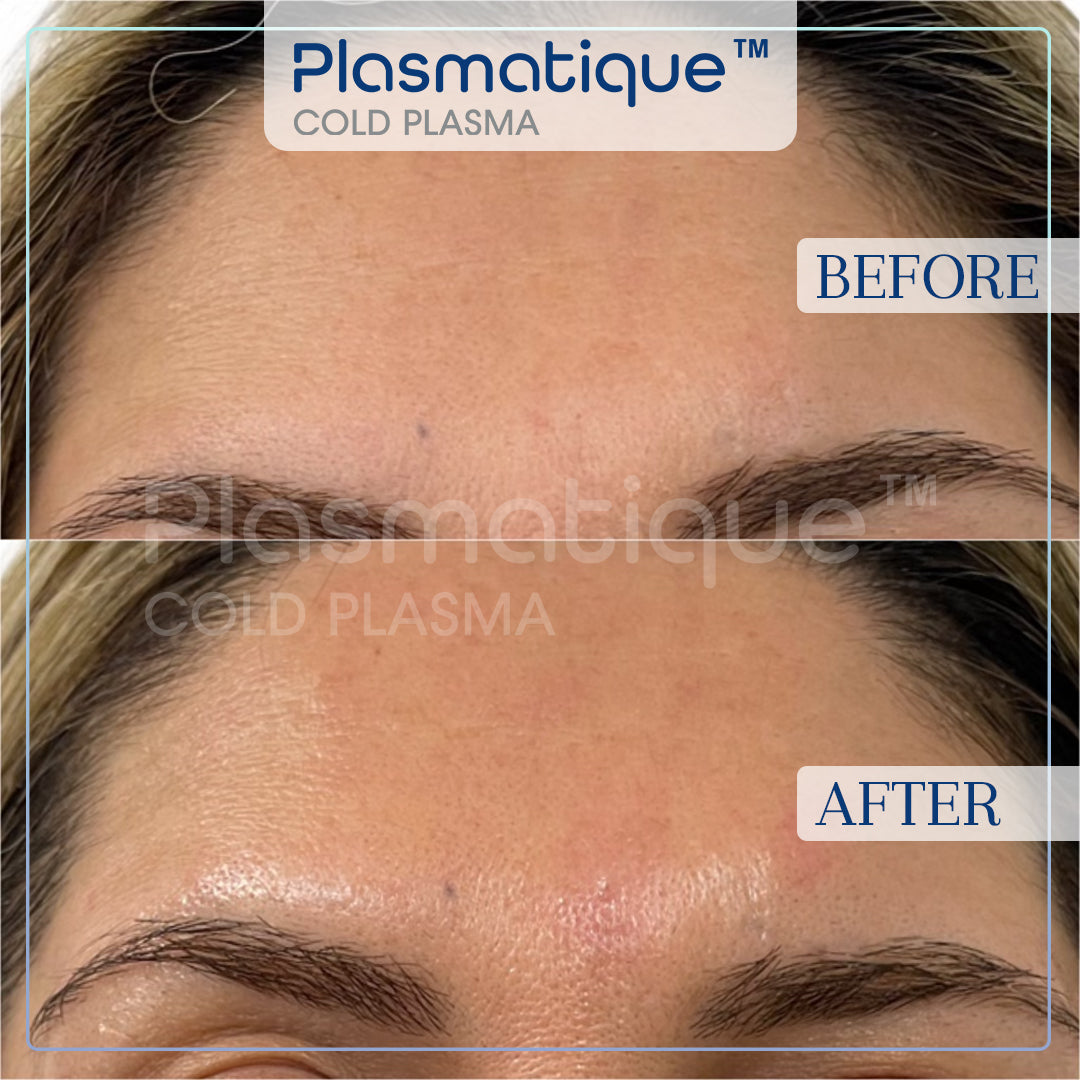 Plasmatique Cold Plasma Device Official Kit and Free Certification