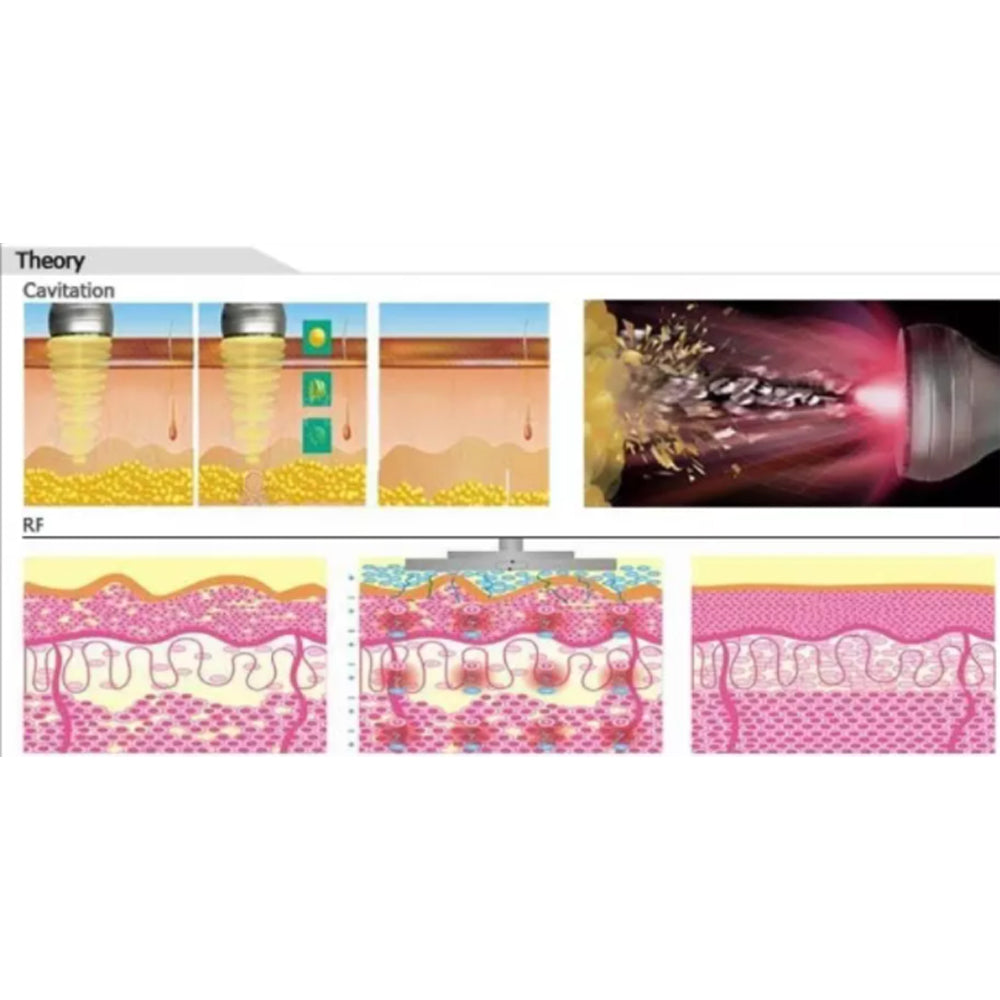 Máquina de adelgazamiento por cavitación multifunción para el cuerpo 
