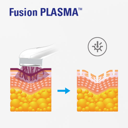 Dispositivo de plasma de fusión de hojas